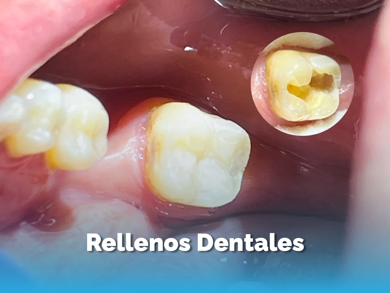 Rellenos Dentales - Top Dental