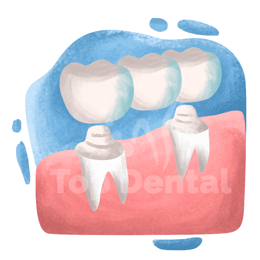 Dentadura Parcial - Top Dental