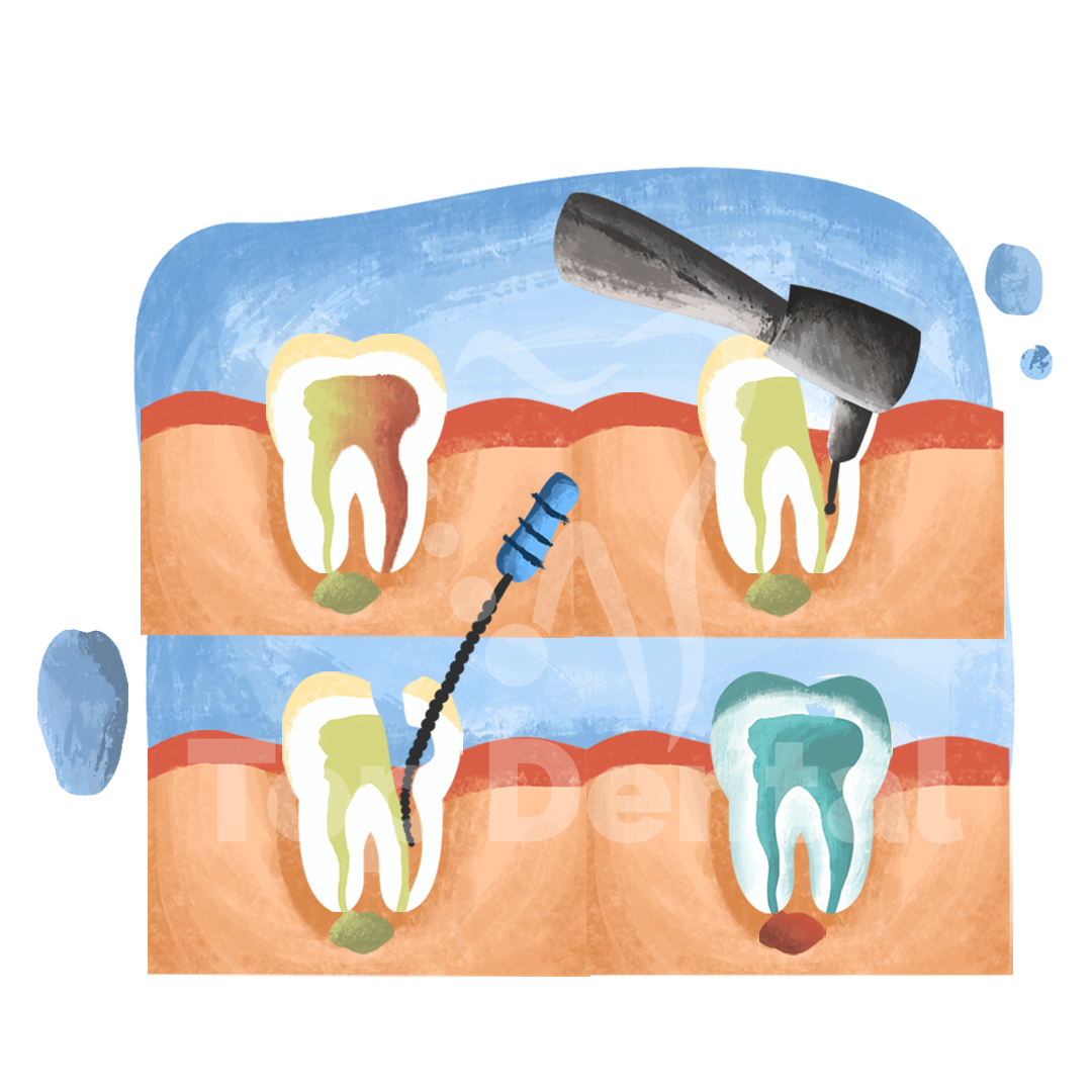 endodoncia