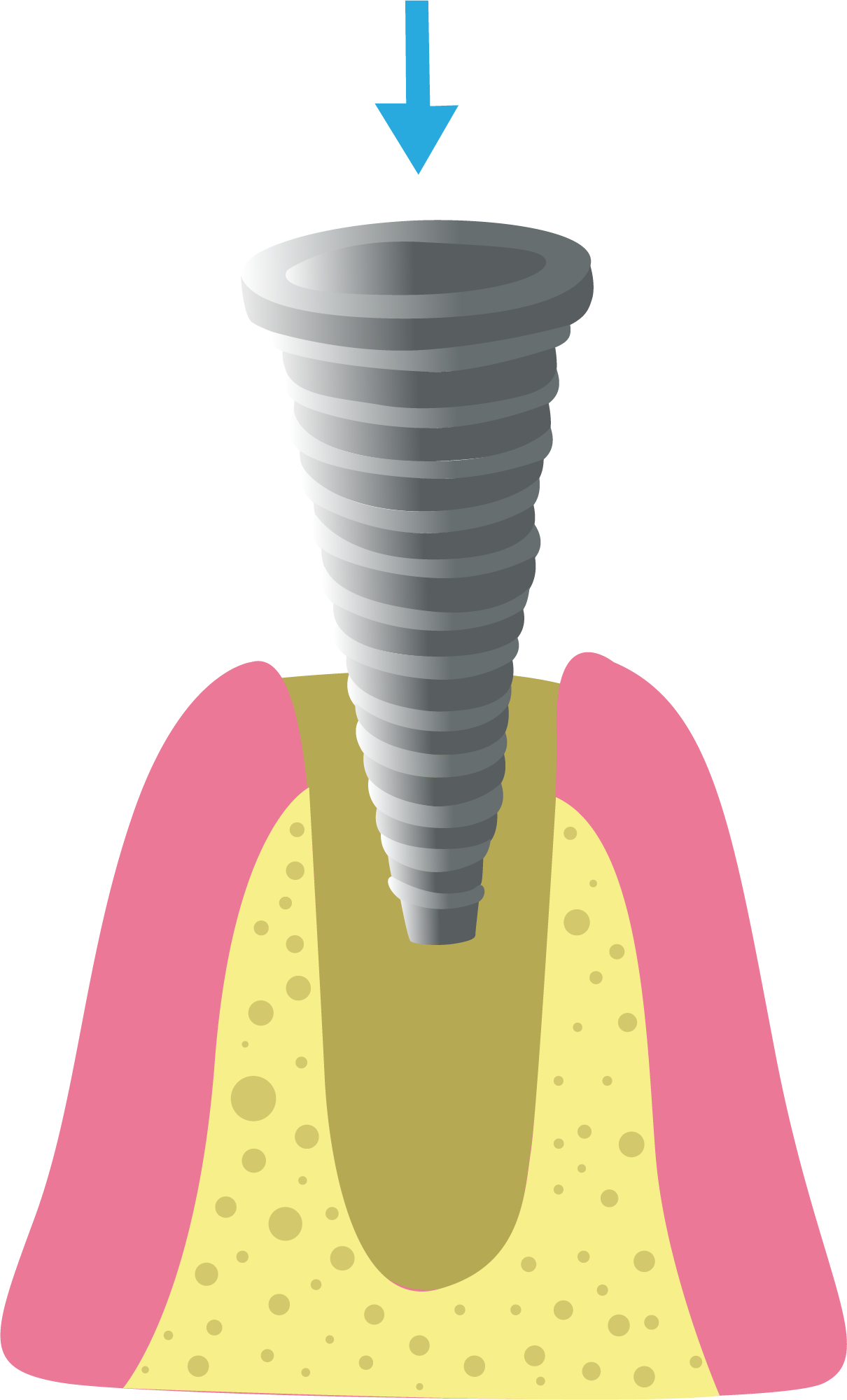 Paso 1: Colocación del Implante Dental - Top Dental