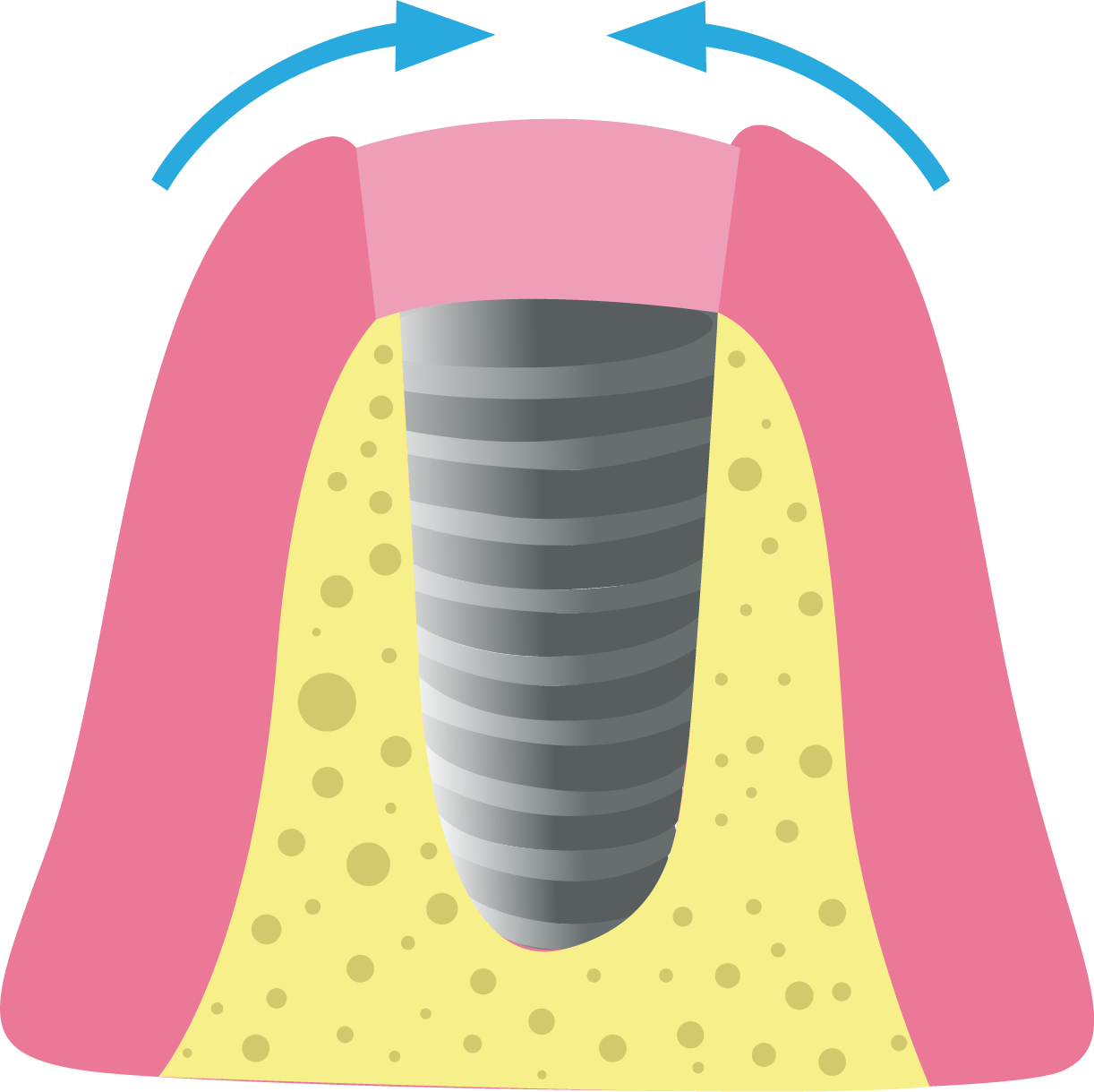 Paso 2: Exposición del Implante Dental - Top Dental