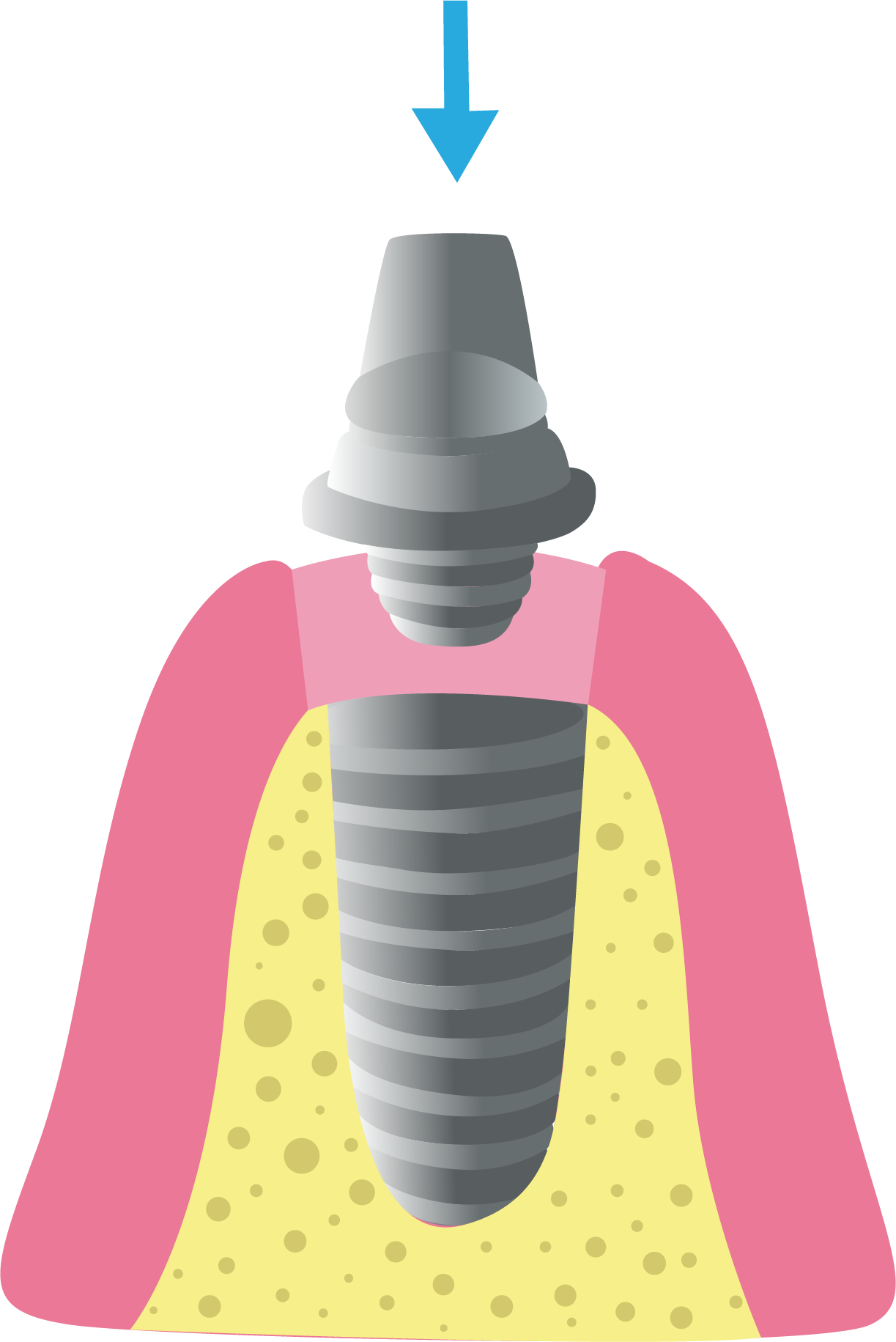 Paso 3: Colocación del Pilar - Top Dental