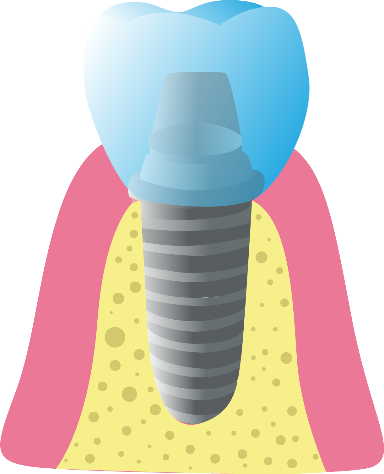 Paso 4: Creación de la Corona Dental - Top Dental