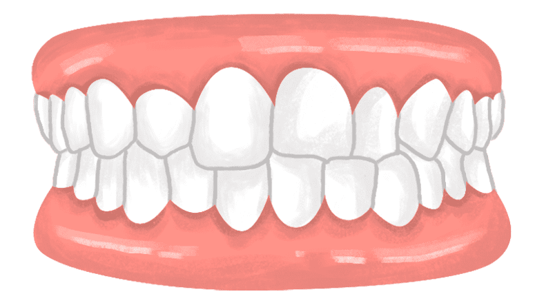 CROSSBITE