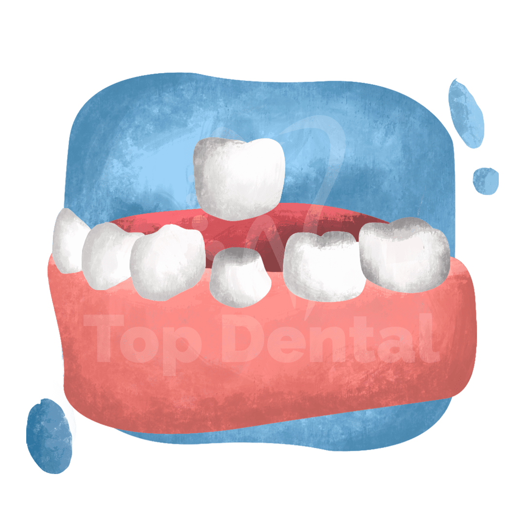 Protege tus dientes con Coronas Dentales en Top Dental