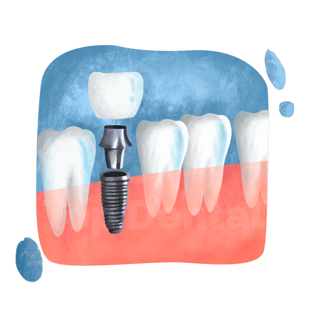 Implantes Dentales en Top Dental