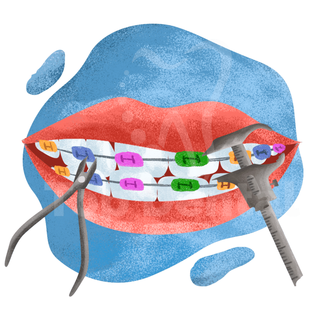 Brackets Metálicos, Ortodoncia, Ortodoncista en Top Dental