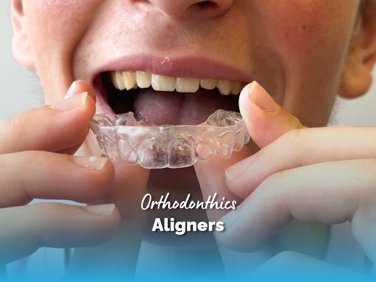 Invisible Aligners - Top Dental