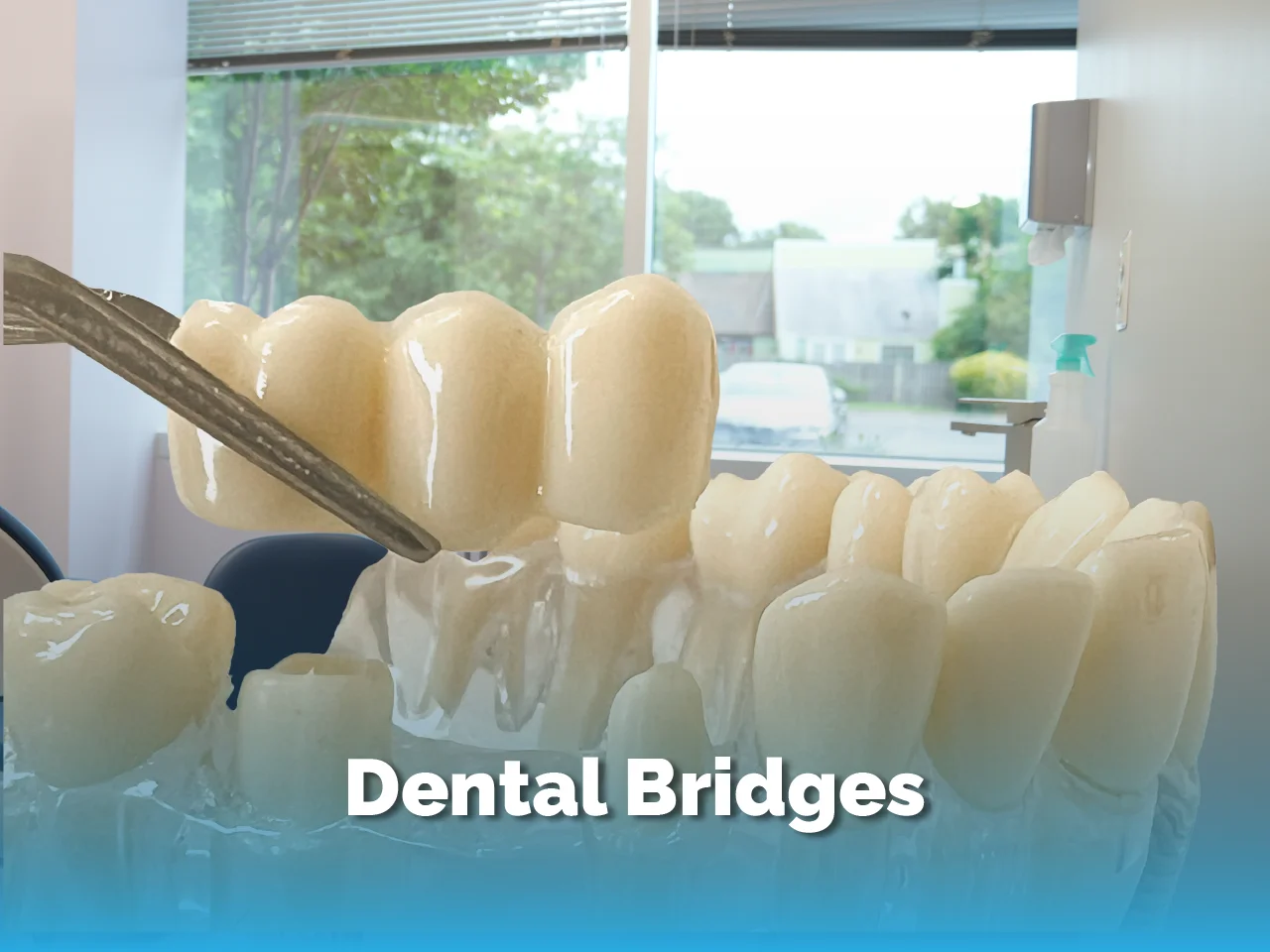 Dental Bridge - Top Dental