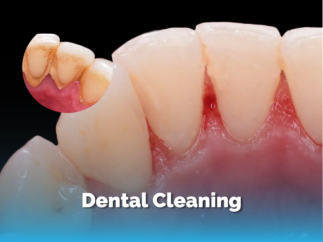 Dental Cleaning - Top Dental