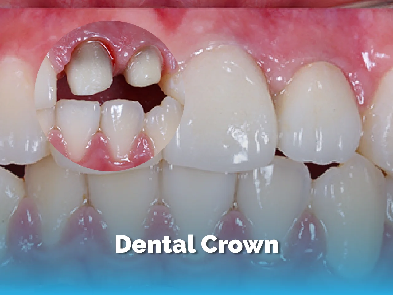 Dental Crown - Top Dental