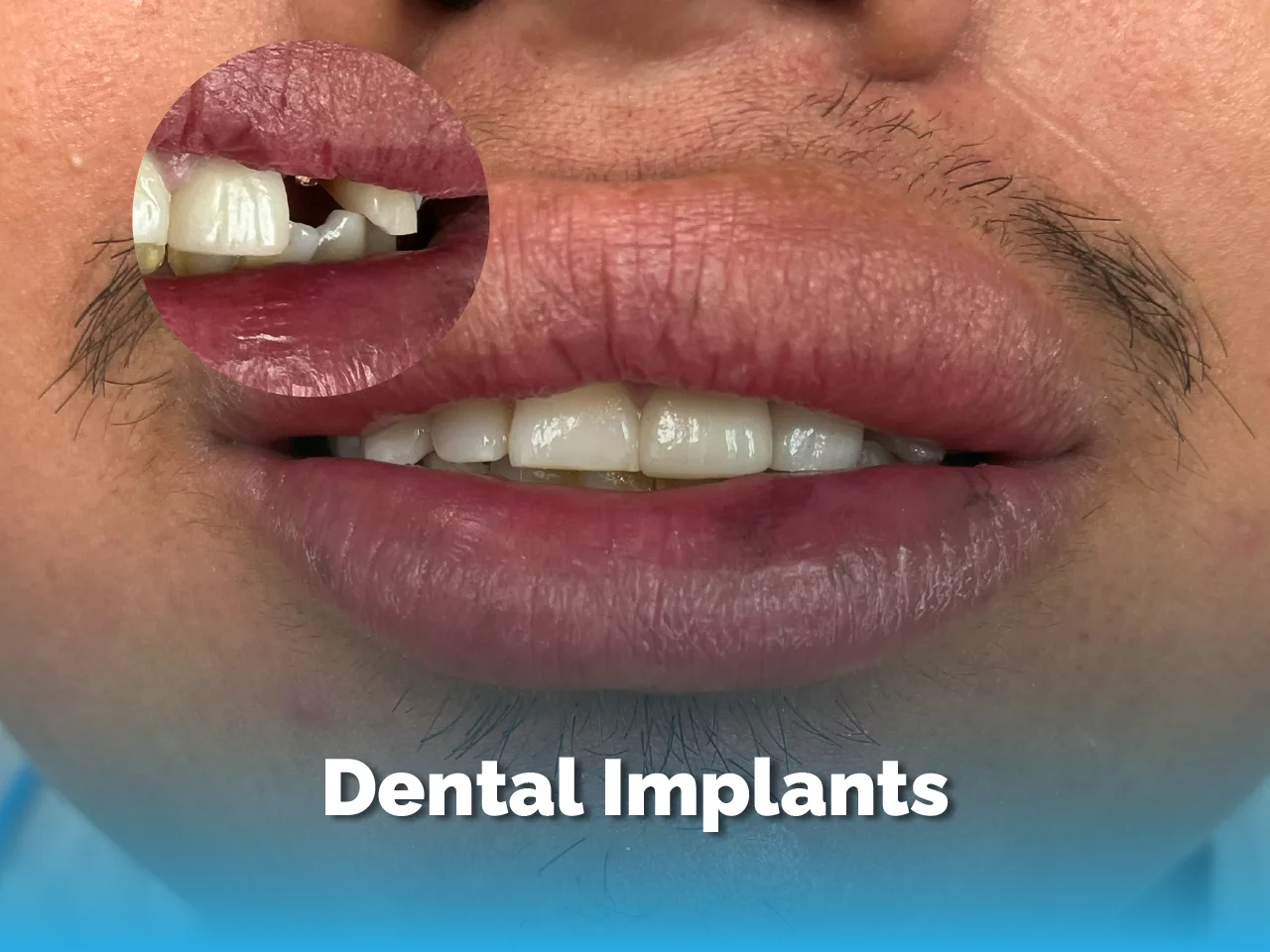 Dental Implant - Top Dental