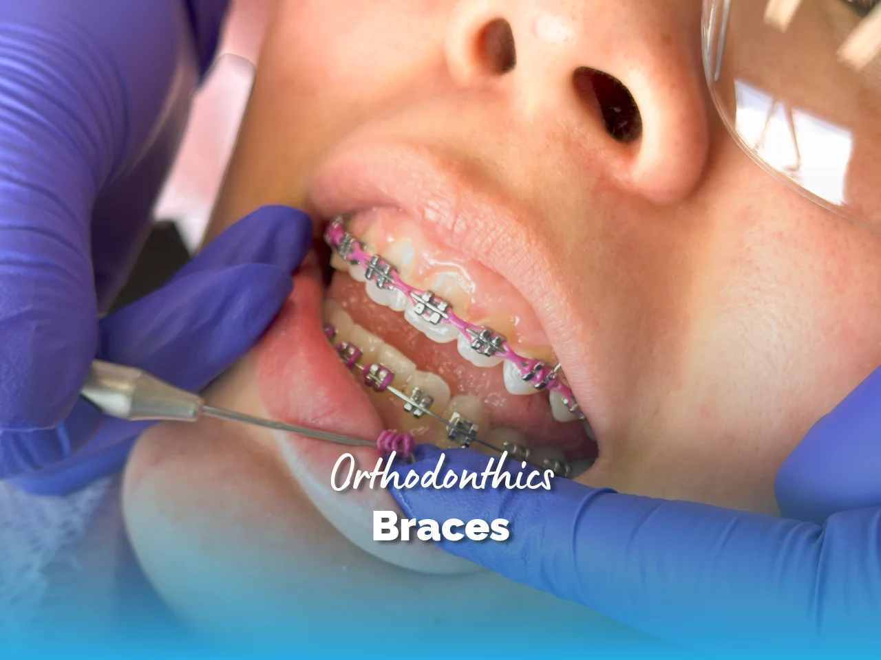 Braces - Top Dental