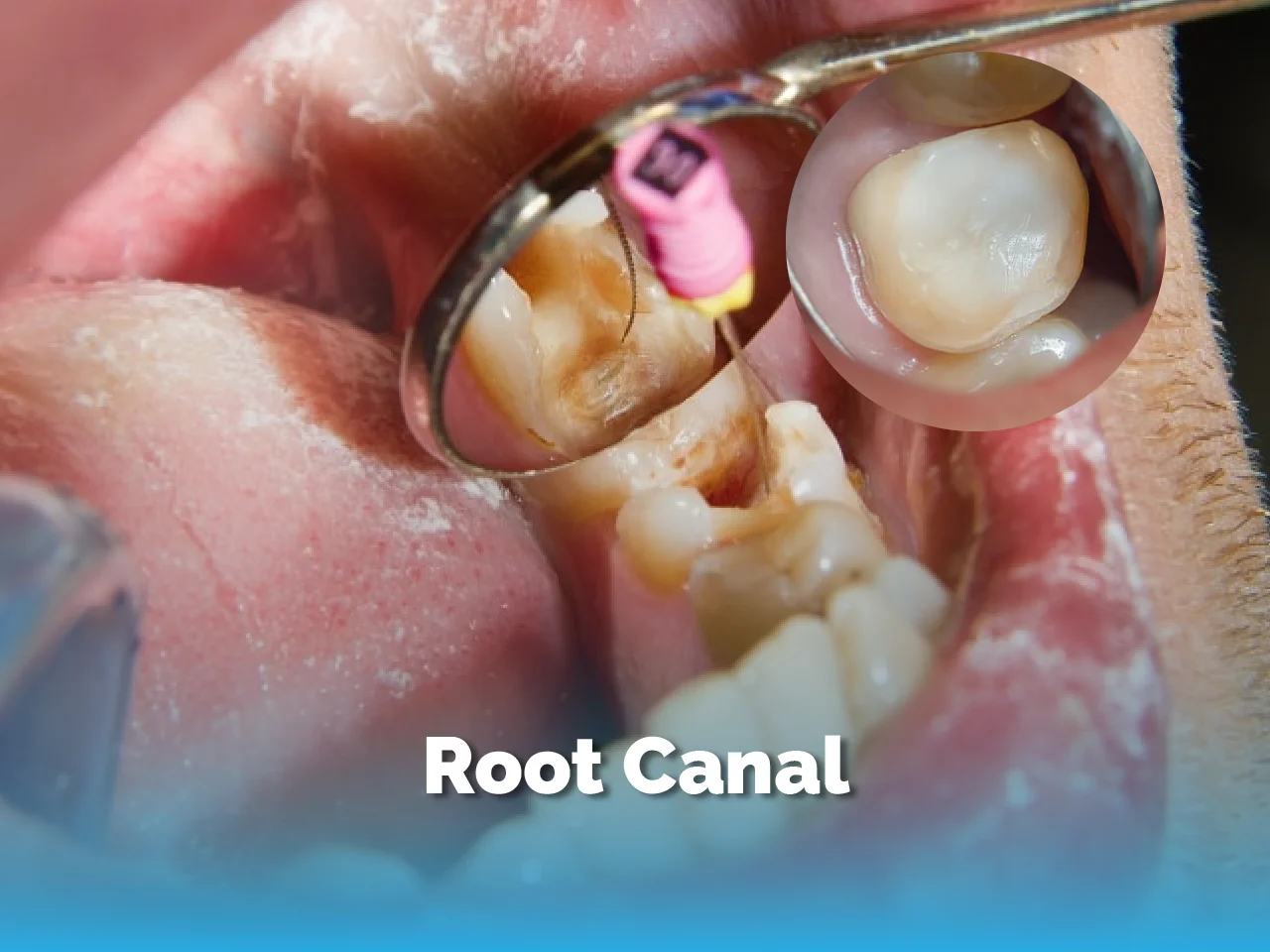 Root Canal - Top Dental