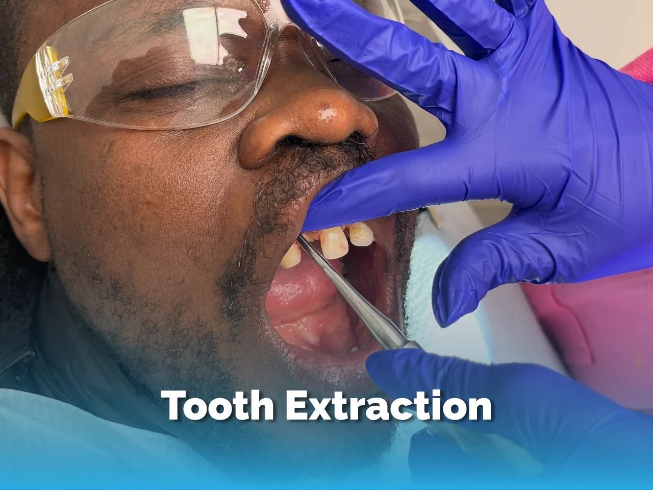 Tooth Extraction - Top Dental