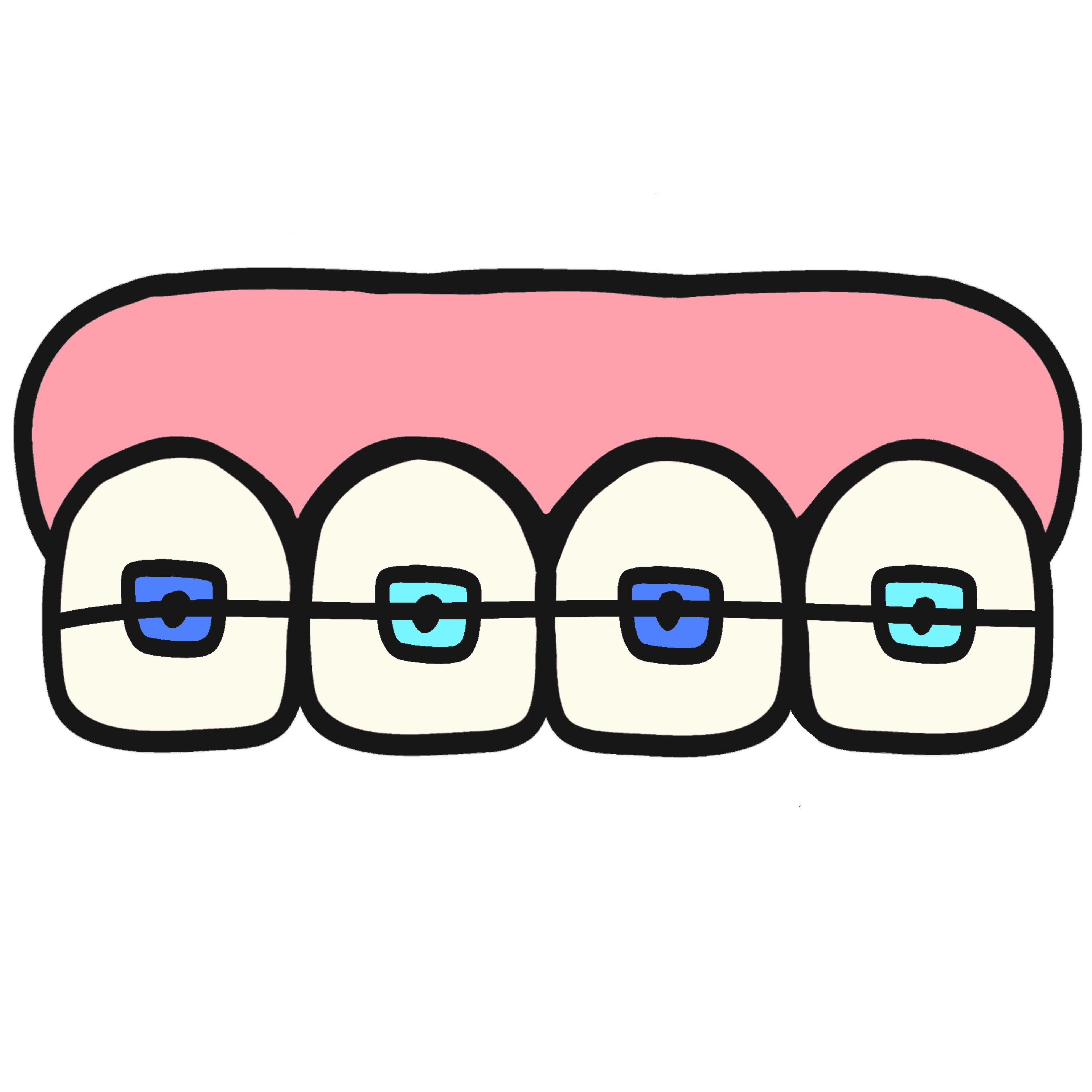 Traditional Metal Braces for Long-Term Smile Alignment at Top Dental