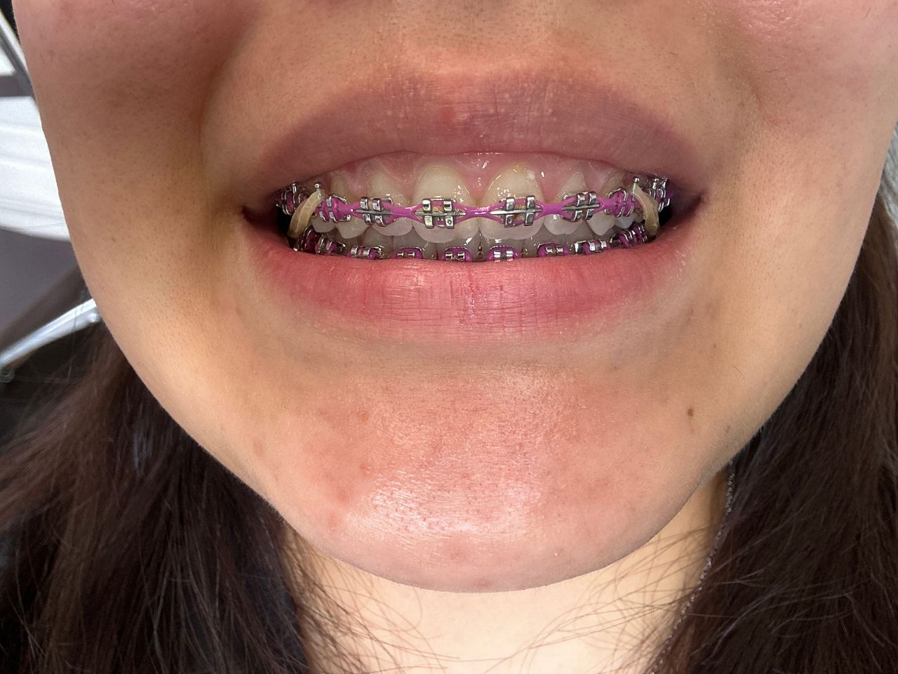 Top Dental Metal Braces