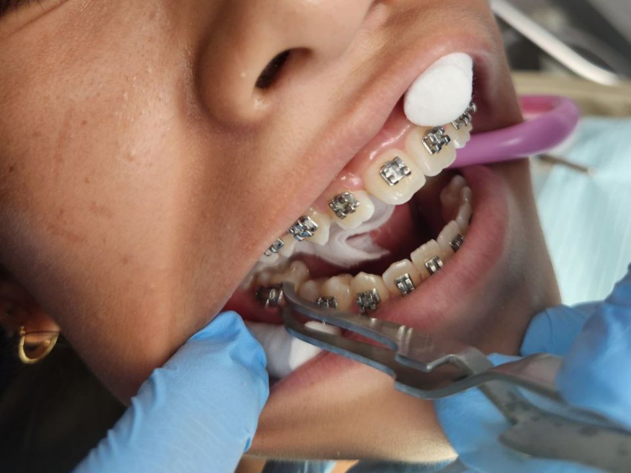 Metal Braces at Top Dental