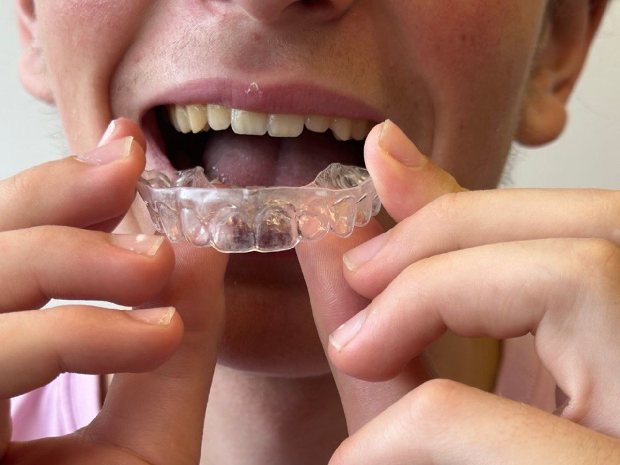 Top Dental Invisible Aligners